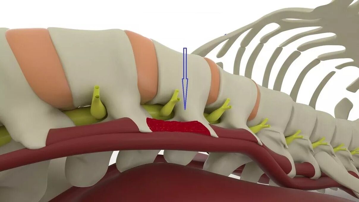 Övfájás a térdízületben - Fájdalom az alsó hátfájásban: okai és kezelése